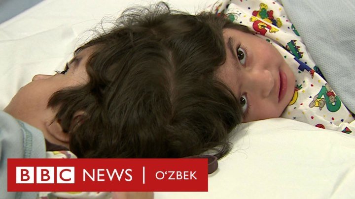 Ўзбекистон ва дунё: Бош суяги қўшилган Сафа ва Марва қандай ажратилди?- BBC Uzbek