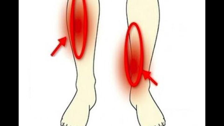 Сильные боли ноги ниже колена причины. Воспаление надкостницы голени (шинсплинт). Периостит надкостницы голени.