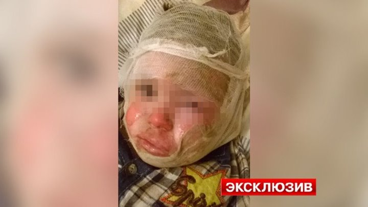 В Ульяновске коллектор поджег ребёнка за долги родителей
