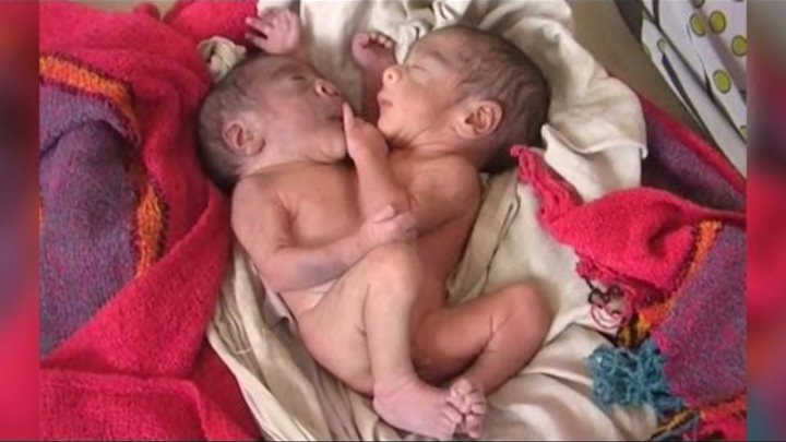 Indian Baby Born With 2 Heads and 4 Arms