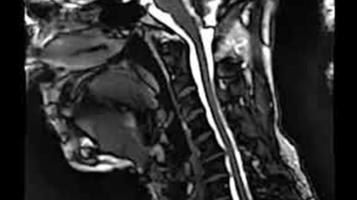 МРТ Шейного отдела позвоночника | Neck MRI examination