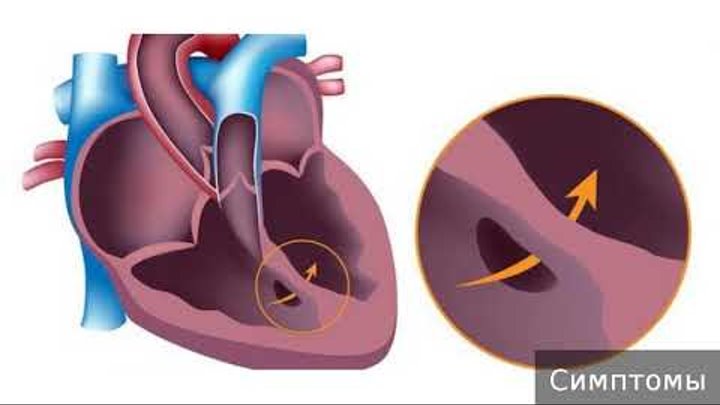 Врожденный порок сердца. Как лечить врожденный порок сердца.