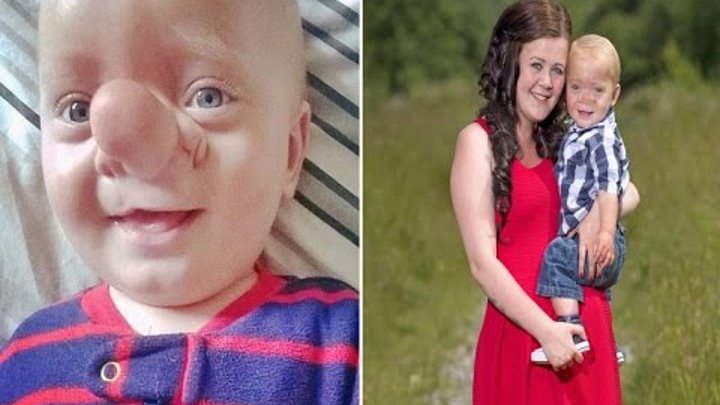 Real life Pinocchio Baby born with his brain growing into NOSE due to his skull not forming properly