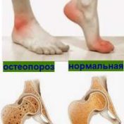 Диффузный остеопороз бедренной кости. Остеопороз тазобедренного сустава симптомы. Транзиторный остеопороз. Остеопороз стопы что это. Уменьшение плотности костной ткани.