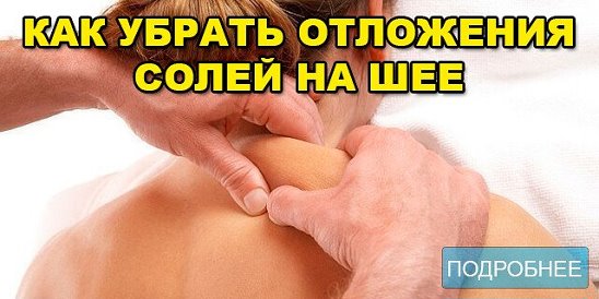 Шейное отложение солей. Остеохондроз шейного отдела отложение солей. Отложение солей в шейном отделе массаж. Отложение солей воротниковой зоны.